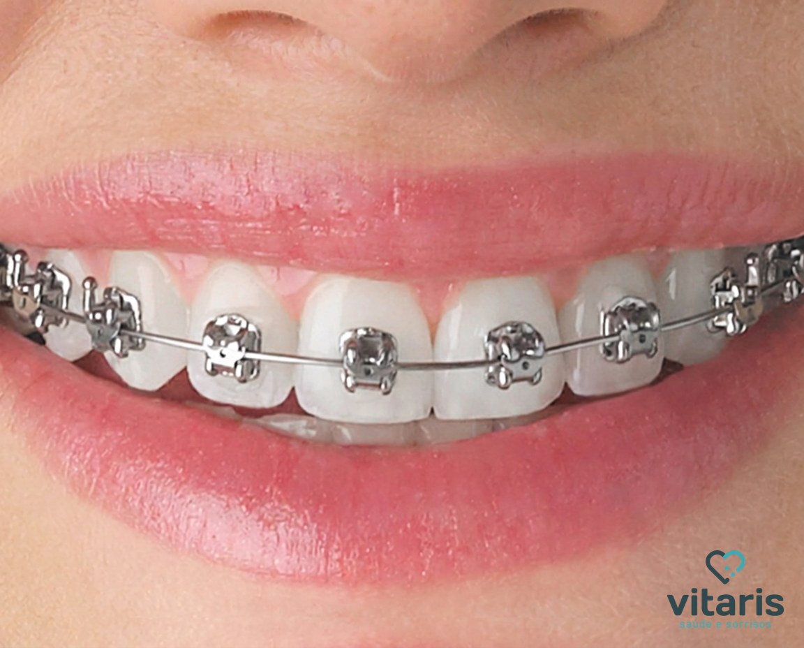 Sorriso em close com aparelho autoligado de braquetes metálicos com clipes integrados